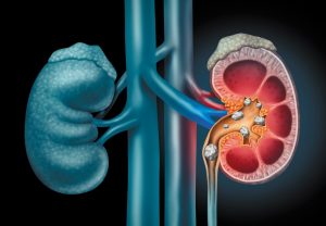 cirurgia de cálculo renal